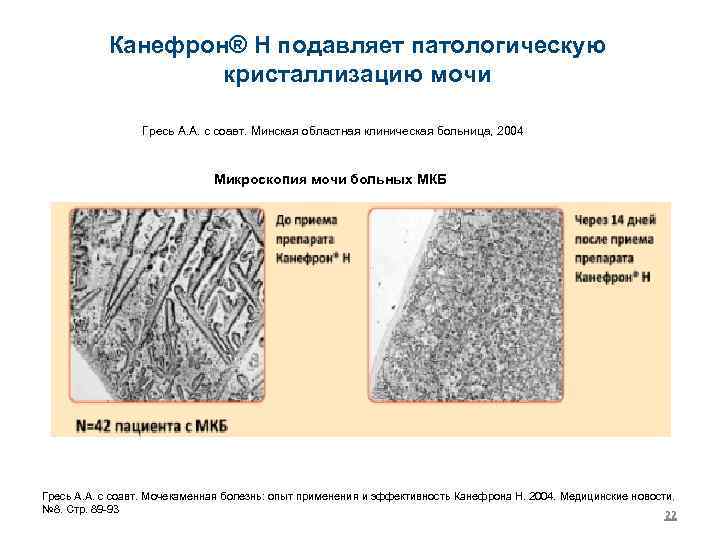 Канефрон® Н подавляет патологическую кристаллизацию мочи Гресь А. А. с соавт. Минская областная клиническая