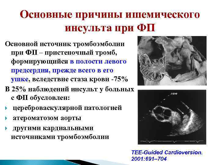 Основные причины ишемического инсульта при ФП Основной источник тромбоэмболии при ФП – пристеночный тромб,