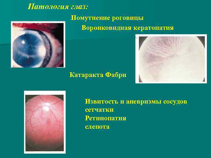 Патология глаз: Помутнение роговицы Воронковидная кератопатия Катаракта Фабри Извитость и аневризмы сосудов сетчатки Ретинопатия