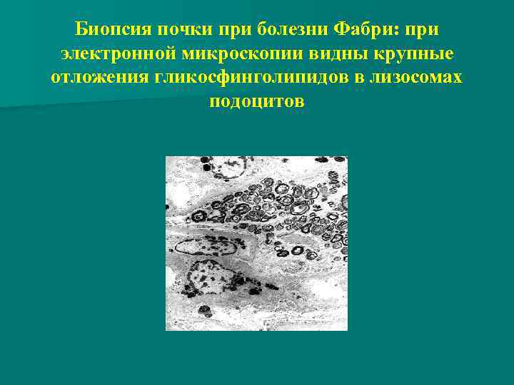 Биопсия почки при болезни Фабри: при электронной микроскопии видны крупные отложения гликосфинголипидов в лизосомах