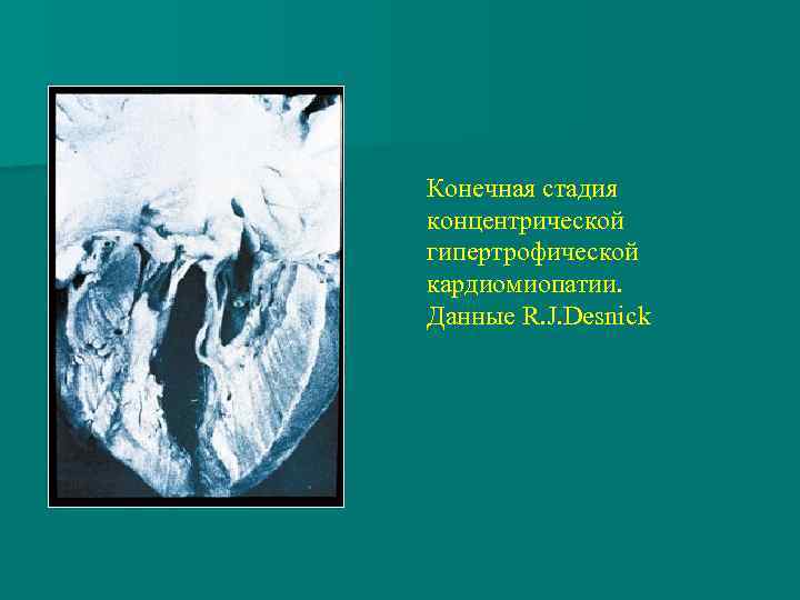 Конечная стадия концентрической гипертрофической кардиомиопатии. Данные R. J. Desnick 