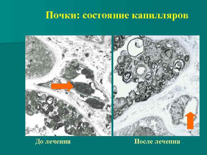 Почки: состояние капилляров До лечения После лечения 