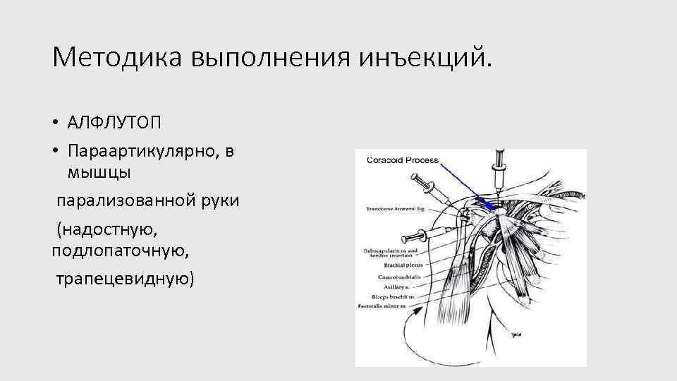 Методика выполнения инъекций. • АЛФЛУТОП • Параартикулярно, в мышцы парализованной руки (надостную, подлопаточную, трапецевидную)