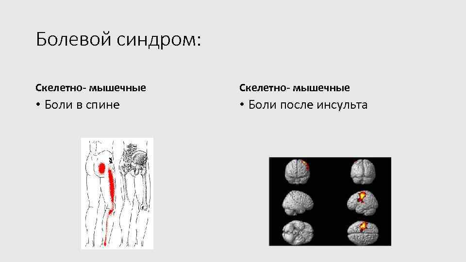 Болевой синдром: Скелетно- мышечные • Боли в спине • Боли после инсульта 