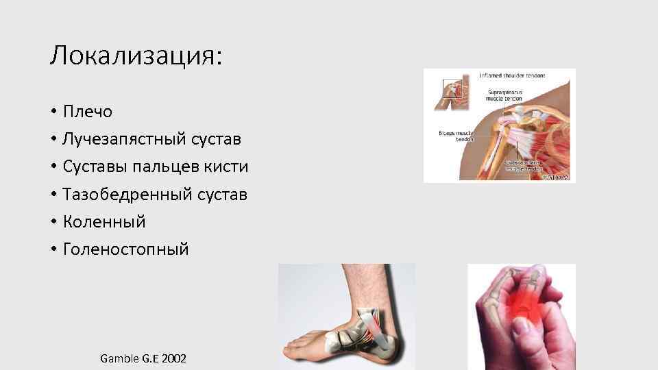 Локализация: • Плечо • Лучезапястный сустав • Суставы пальцев кисти • Тазобедренный сустав •