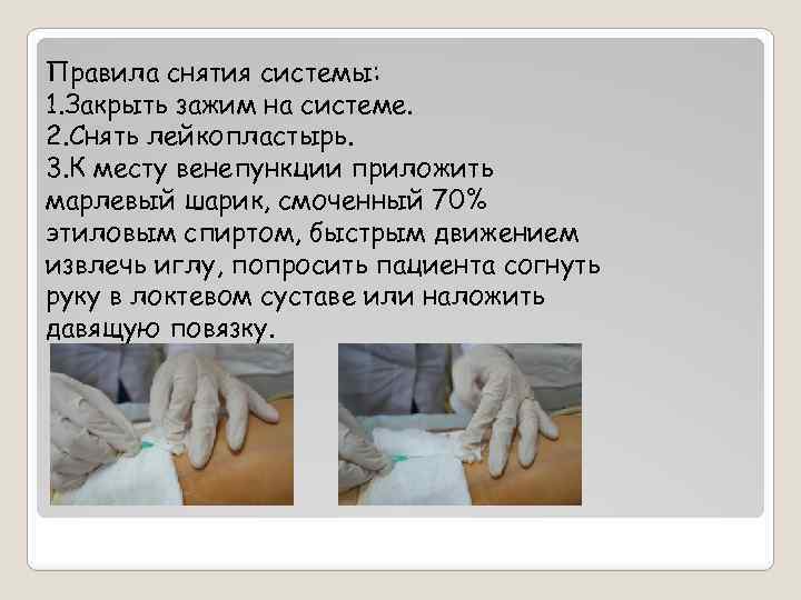Правила снятия системы: 1. Закрыть зажим на системе. 2. Снять лейкопластырь. 3. К месту