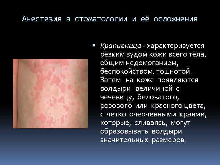 Анестезия в стоматологии и её осложнения Крапивница - характеризуется резким зудом кожи всего тела,