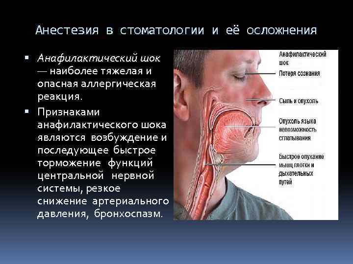 Мандибулярная анестезия в стоматологии схема проведения видео