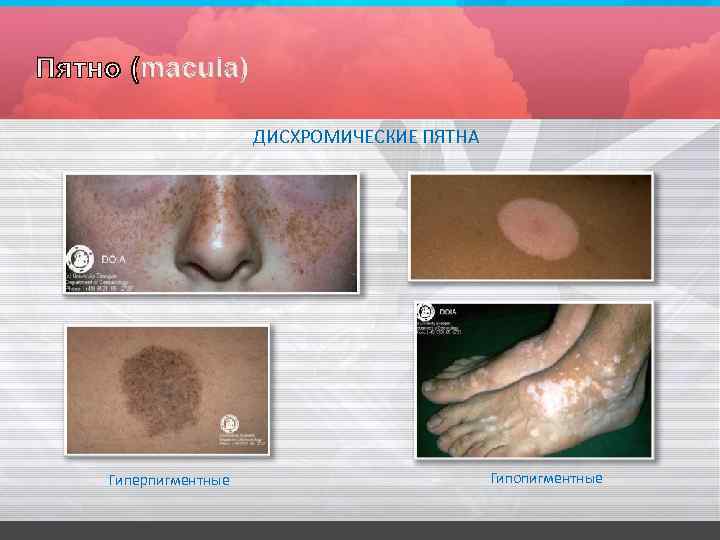 ДИСХРОМИЧЕСКИЕ ПЯТНА Гиперпигментные Гипопигментные 