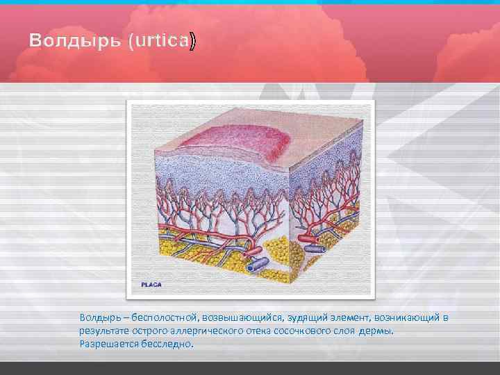 Волдырь – бесполостной, возвышающийся, зудящий элемент, возникающий в результате острого аллергического отека сосочкового слоя