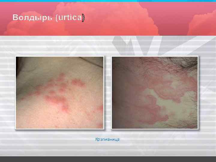 Крапивница 