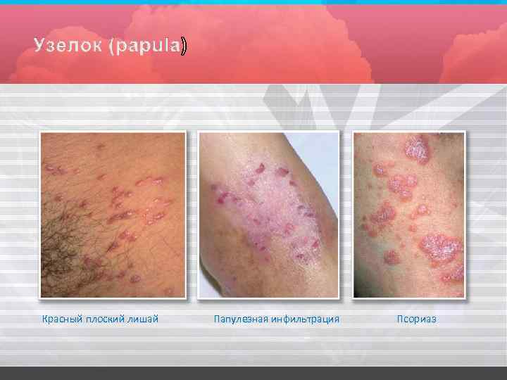 Красный плоский лишай Папулезная инфильтрация Псориаз 