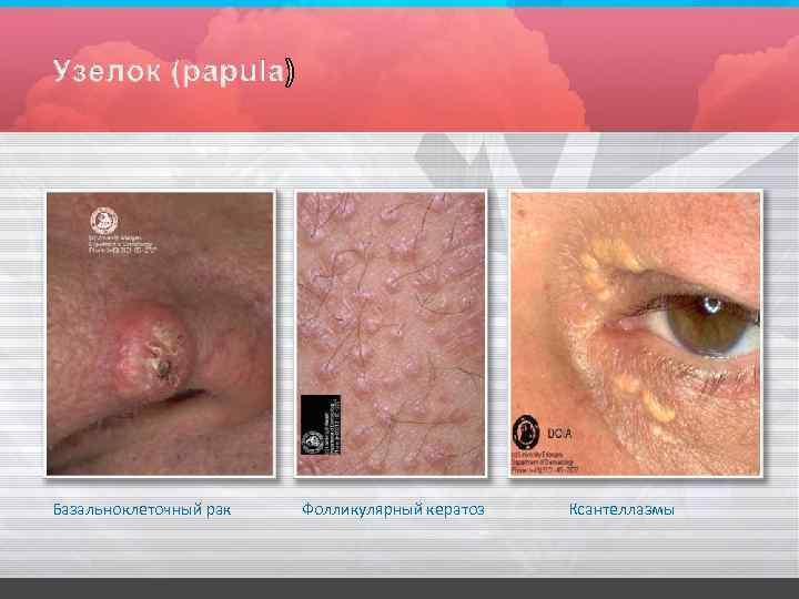 Базальноклеточный рак Фолликулярный кератоз Ксантеллазмы 