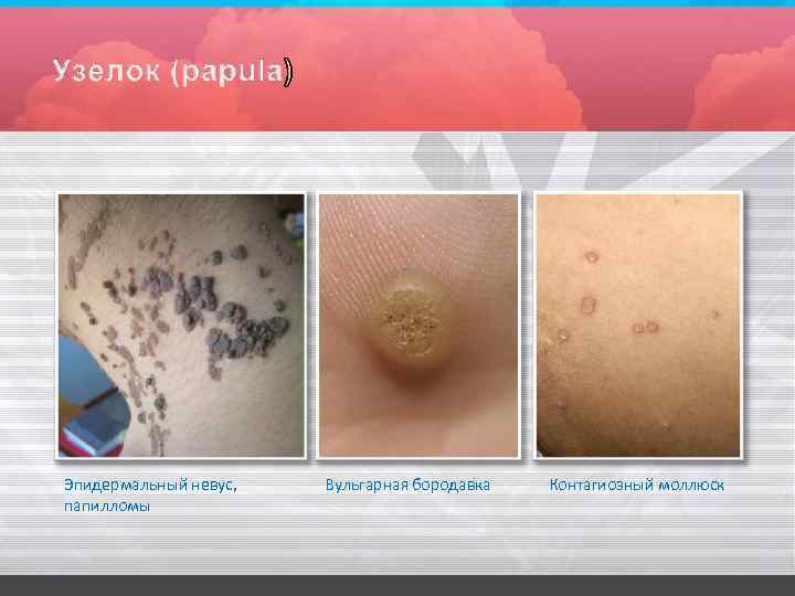 Эпидермальный невус, папилломы Вульгарная бородавка Контагиозный моллюск 