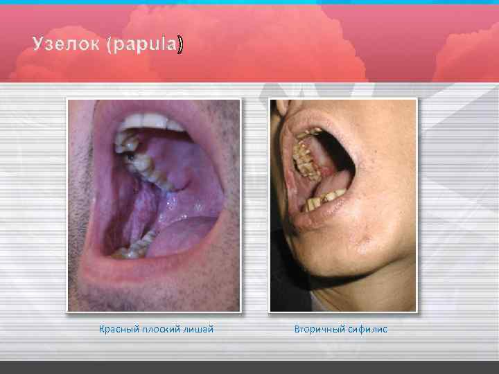 Красный плоский лишай Вторичный сифилис 