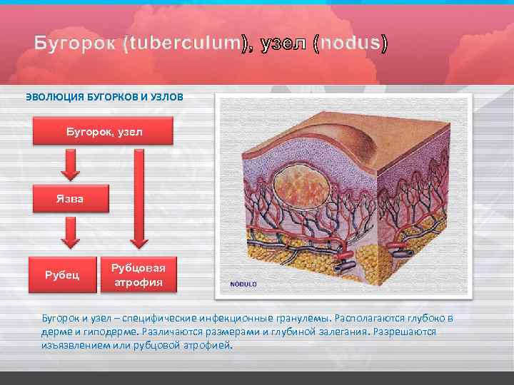 ЭВОЛЮЦИЯ БУГОРКОВ И УЗЛОВ Бугорок, узел Язва Рубец Рубцовая атрофия Бугорок и узел –