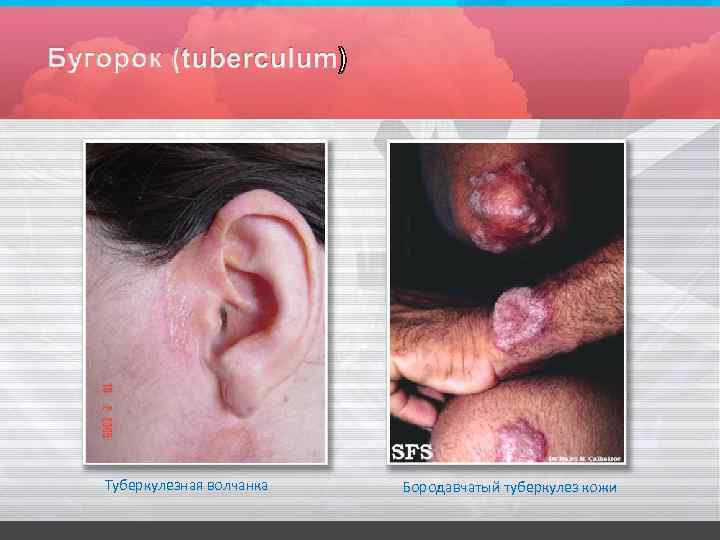 Туберкулезная волчанка Бородавчатый туберкулез кожи 