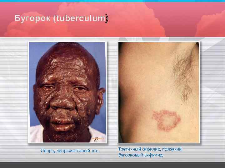 Лепра, лепроматозный тип Третичный сифилис, ползучий бугорковый сифилид 