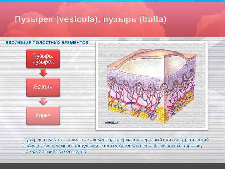 Волдырь элемент. Пузырь первичный элемент. Первичные элементы сыпи полостные. Морфологические элементы кожи волдыри.