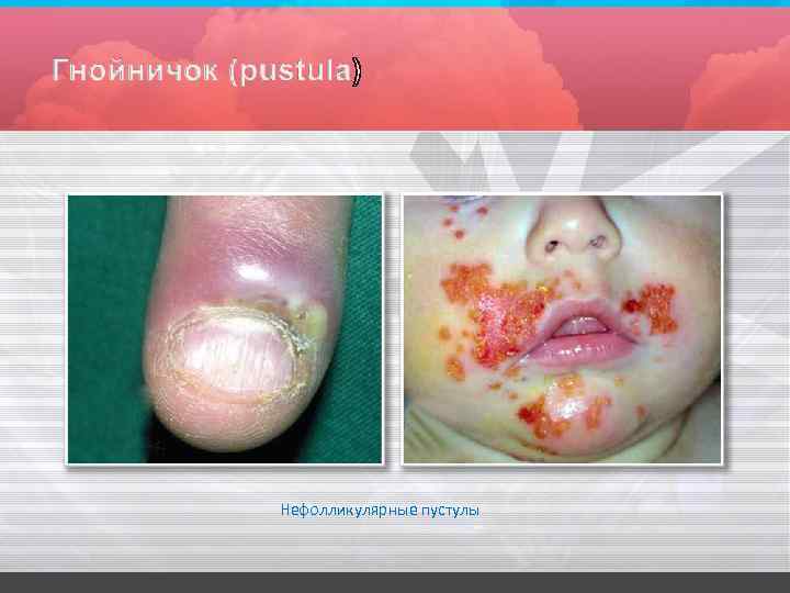Нефолликулярные пустулы 