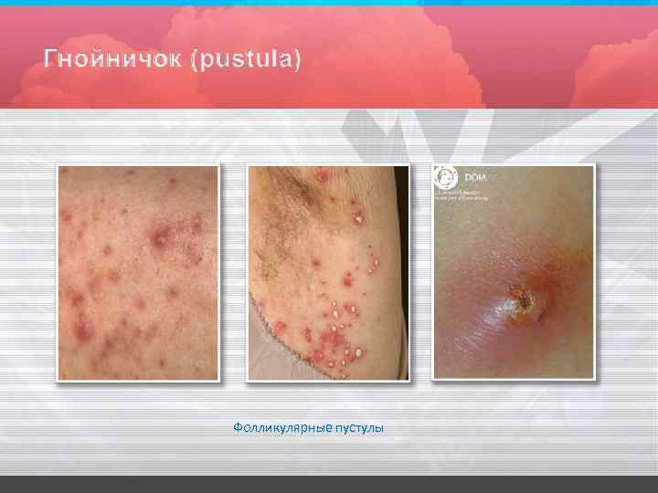 Фолликулярные пустулы 