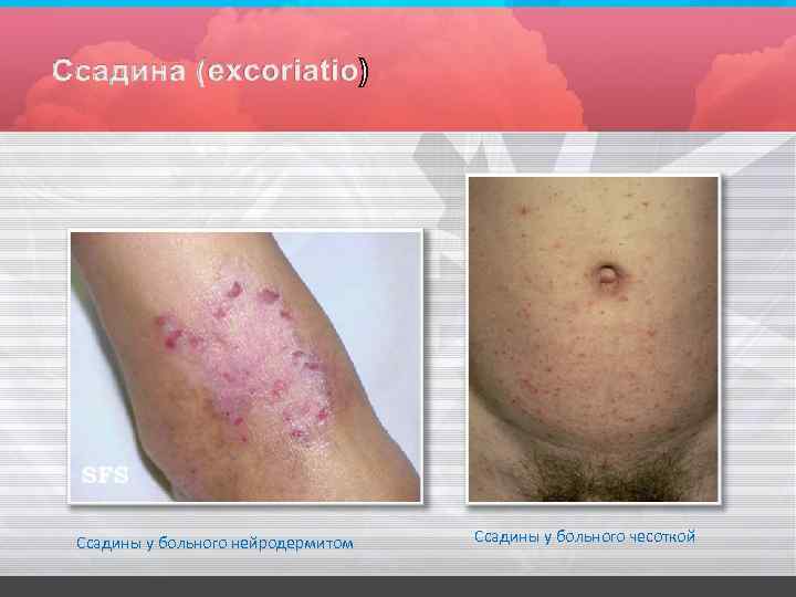 Ссадины у больного нейродермитом Ссадины у больного чесоткой 