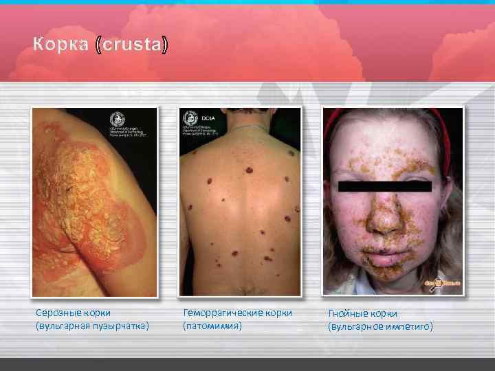 Серозные корки (вульгарная пузырчатка) Геморрагические корки (патомимия) Гнойные корки (вульгарное импетиго) 