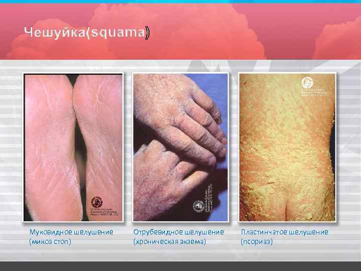 Муковидное шелушение (микоз стоп) Отрубевидное шелушение (хроническая экзема) Пластинчатое шелушение (псориаз) 