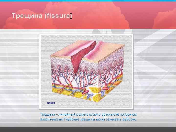 Трещина – линейный разрыв кожи в результате потери ею эластичности. Глубокие трещины могут заживать