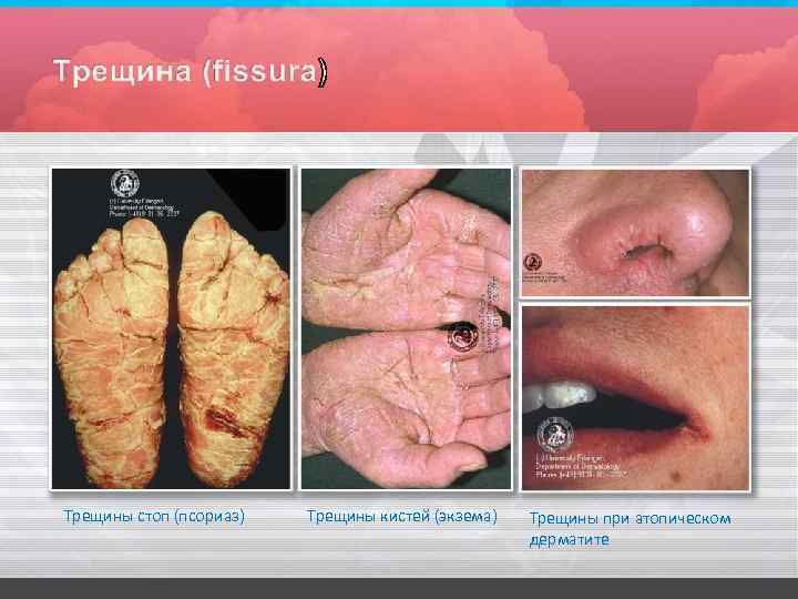 Трещины стоп (псориаз) Трещины кистей (экзема) Трещины при атопическом дерматите 
