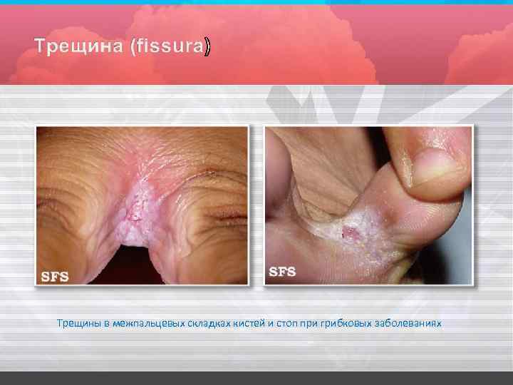 Трещины в межпальцевых складках кистей и стоп при грибковых заболеваниях 