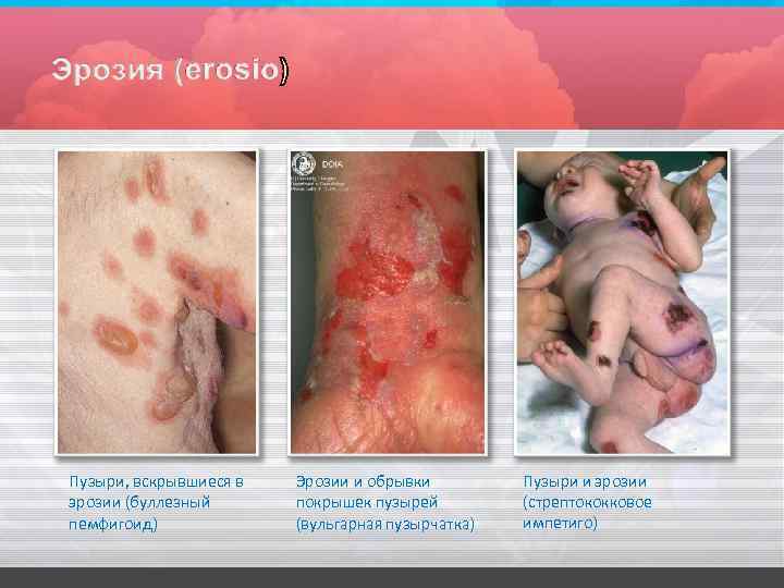 Пузыри, вскрывшиеся в эрозии (буллезный пемфигоид) Эрозии и обрывки покрышек пузырей (вульгарная пузырчатка) Пузыри