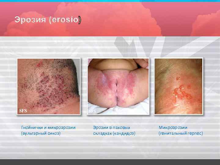 Гнойнички и микроэрозии (вульгарный сикоз) Эрозии в паховых складках (кандидоз) Микроэрозии (генитальный герпес) 