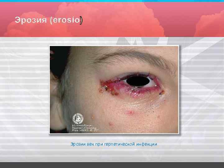 Эрозии век при герпетической инфекции 