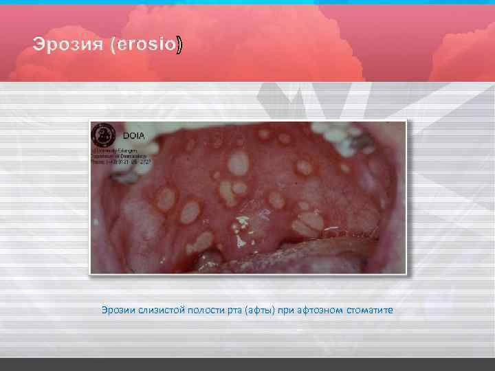 Эрозии слизистой полости рта (афты) при афтозном стоматите 