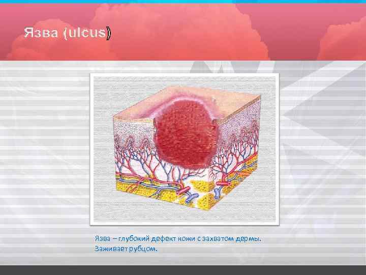 Язва – глубокий дефект кожи с захватом дермы. Заживает рубцом. 
