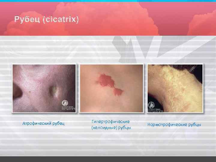 Атрофический рубец Гипертрофические (келоидные) рубцы Нормотрофические рубцы 
