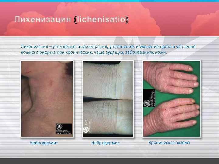 Лихенизация – утолщение, инфильтрация, уплотнение, изменение цвета и усиление кожного рисунка при хронических, чаще