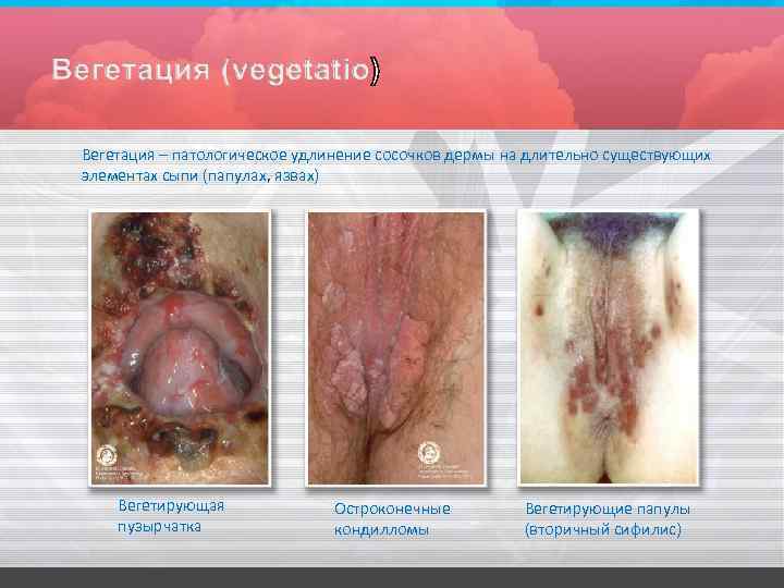 Вегетация – патологическое удлинение сосочков дермы на длительно существующих элементах сыпи (папулах, язвах) Вегетирующая