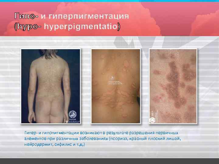 Гипер- и гипопигментации возникают в результате разрешения первичных элементов при различных заболеваниях (псориаз, красный