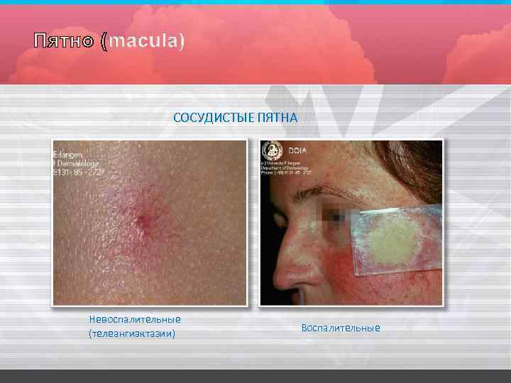СОСУДИСТЫЕ ПЯТНА Невоспалительные (телеангиэктазии) Воспалительные 