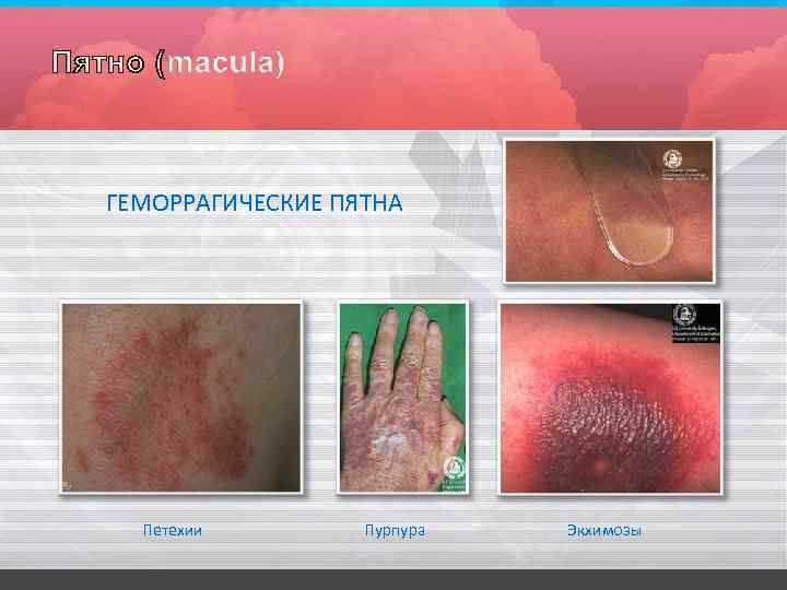 ГЕМОРРАГИЧЕСКИЕ ПЯТНА Петехии Пурпура Экхимозы 