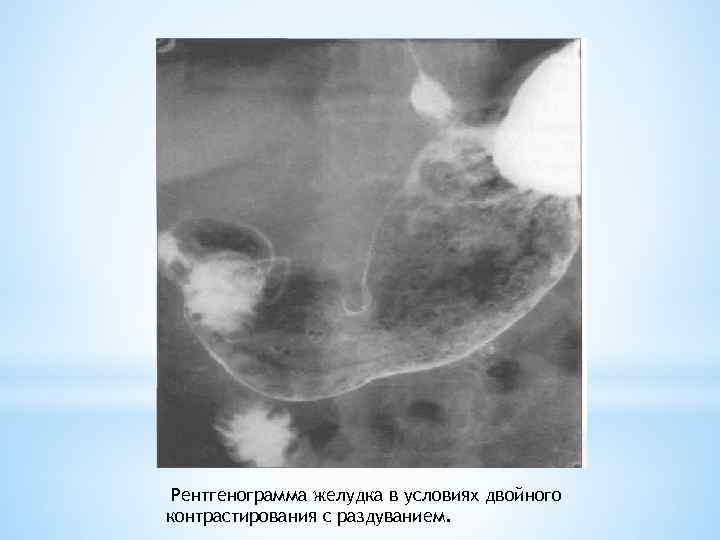 Рентгенограмма желудка в условиях двойного контрастирования с раздуванием. 