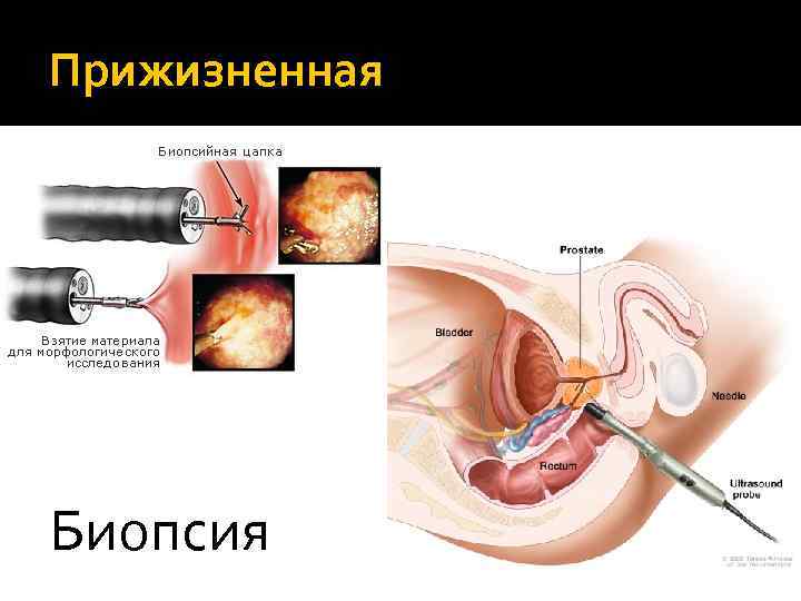 Прижизненная Биопсия 