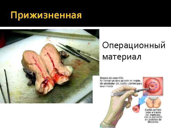 Прижизненная Операционный материал 