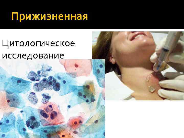 Прижизненная Цитологическое исследование 
