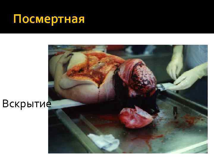 Посмертная Вскрытие 