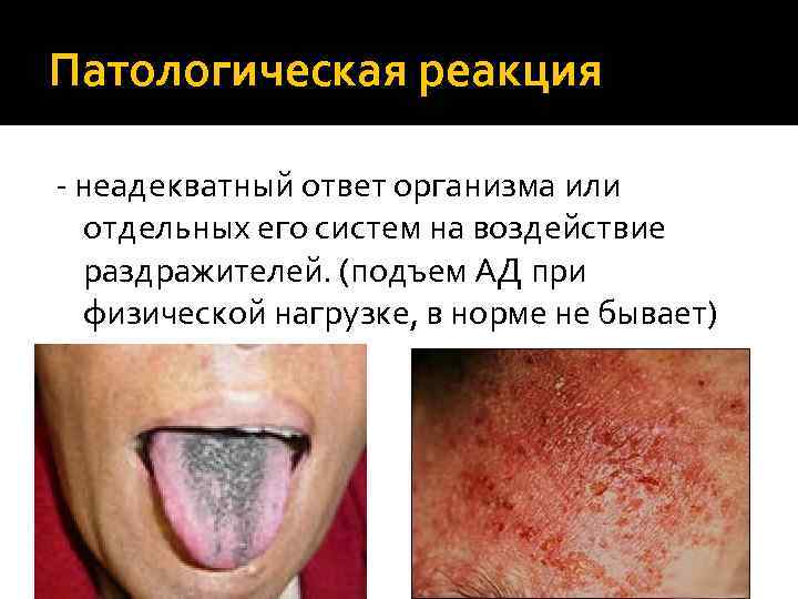 Патологическая реакция - неадекватный ответ организма или отдельных его систем на воздействие раздражителей. (подъем