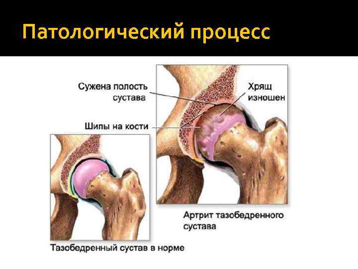 Патологический процесс 