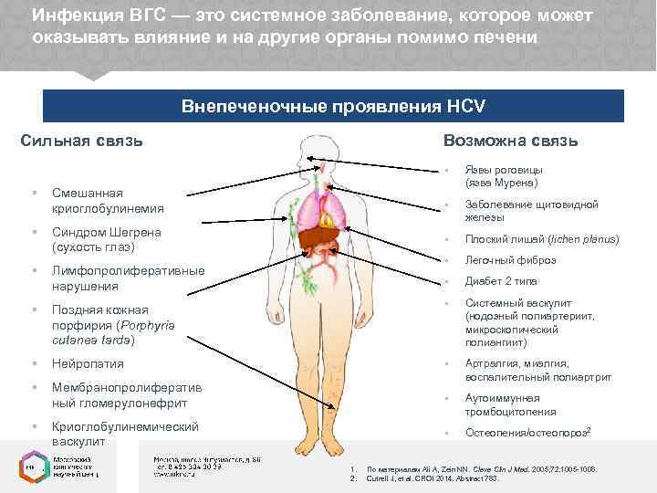 Инфекция ВГС — это системное заболевание, которое может оказывать влияние и на другие органы